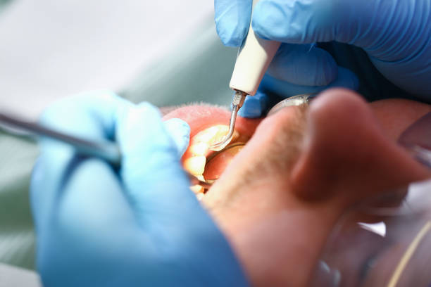 Best Emergency Root Canal Treatment in Tulsa, OK